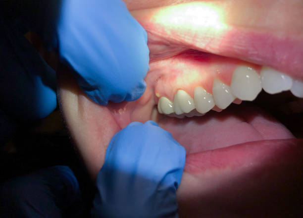 Best Dental Abscess Treatment in Southside, AR